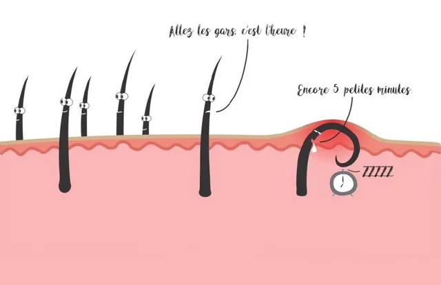 Comment se débarrasser des poils incarnés ?  Suite à